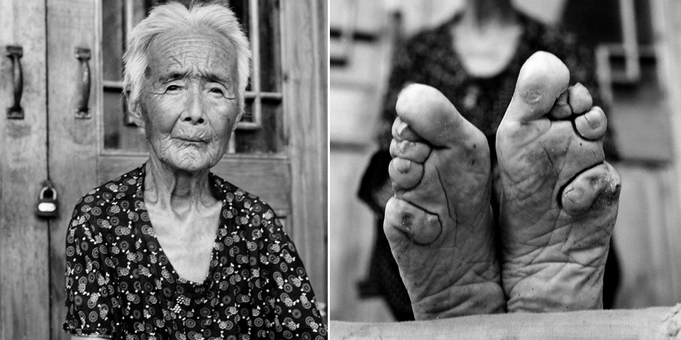 Coutume des pieds bandés en Chine