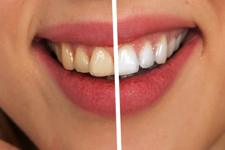Comparatif de dents jaunâtres puis blanchies.