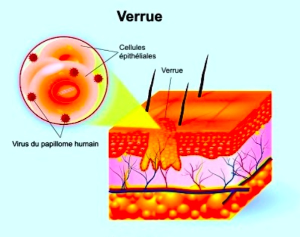 Explication et schéma de la verrue par rapport à la peau